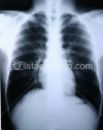 xray - This is my chest X-ray