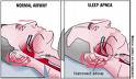 Apnea happens... - Sleep Apnea