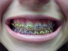 braces - braces
