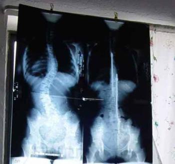 before and after...yo - scoliosis..nasty...yet powerful