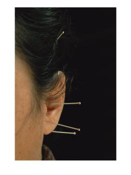 Chinese Traditional Treatment - Acupuncture Treatment