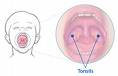 tonsils - tonsils