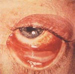 conjunctivitis - conjunctivitis