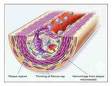 cholesterol - picture of a blood vein getting clogged up my fat due to high cholesterol level.