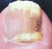 Ok, this is disgusting - toe nail fungus