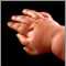 Polydactyly - Extra little finger Polydactyly - Extra little finger