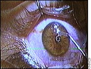 Lasik - Laser eye surgery