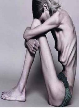 anorexia - A woman with anorexia, they believe that there isn&#039;t such thing as too thin.