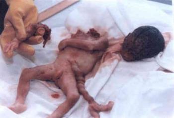 aborted baby - http://www.biblia.com/abortion/photos.htm