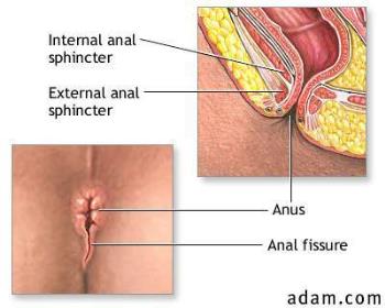 Anal Fissure - Picture depicting an anal fissure which causes severe pain and discomfort in stool as well as accompanied blood