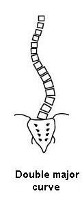 scoliosis curve fairly similar to mine - scoliosis curve that is fairly similar to mine