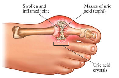 Gout - Shows cross-section of swollen and inflamed joint with masses of uric acid crystals.