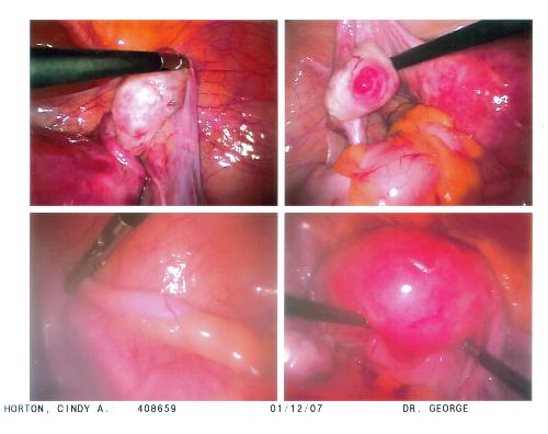 this is what they removed - these are cyst that they removed from me yesterday ouch.