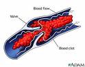 blood clot picture - blood clot in our body