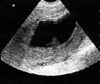 digital view of uterus after abortion!! - abortion or a missed pregnancy or what you call as miss-carriage...