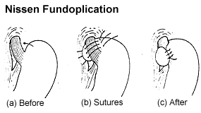 Fundoplication Procedure - the fundoplication procedure, what it does