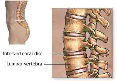 low back pain - lumbar vertebrae
