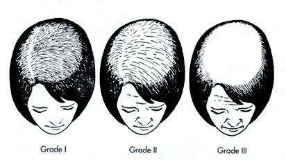 hair fall - hair fall - demo