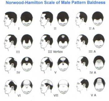 hair fall - hair fall - diagram