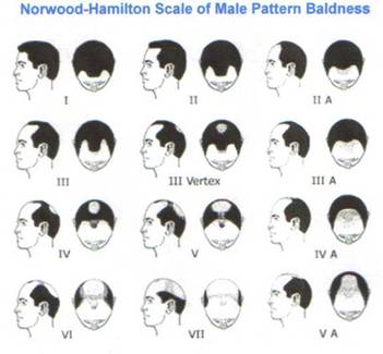 hair loss - hair loss - stages