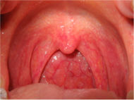 pharyngitis - pharyngitis