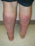 Cellulitus - You can get cellulitis on any part of your body, but it often occurs on the face and legs.
Cellulitis may look very red and spread quickly.
In some cases, there can be red streaks around it.
Cellulitis is serious and someone who has it needs medical attention. It can cause fever, chills, and swollen glands. Bacteria can get into the bloodstream or even the bones nearby and make someone really sick
Cellulitus - You can get cellulitis on any part of your body, but it often occurs on the face and legs.
Cellulitis may look very red and spread quickly.
In some cases, there can be red streaks around it.
Cellulitis is serious and someone who has it needs medical attention. It can cause fever, chills, and swollen glands. Bacteria can get into the bloodstream or even the bones nearby and make someone really sick