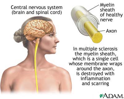 multiple sclerosis - MS...multiple sclerosis...a diseases that effects the central nervous system??