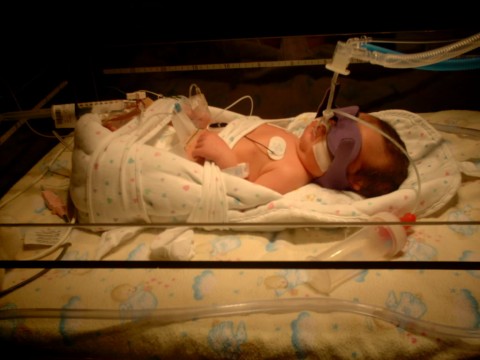 daughter premature in NICU - My daughter was born premature and her lungs were not developed so she was on respirator and feeding tube.