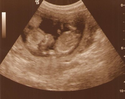my baby's first ultrasound 12/06 - this was my baby in the first ultrasound done 12/27/06