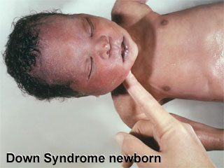 Newborn with down syndrome - a newborn baby with down syndrome
