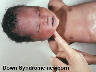 down syndrome newborn - a newborn baby with down syndrome
