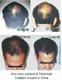 hair loss treatment - this photo is about hair loss treatment which regrowth hair after treatment