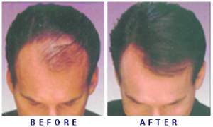 hair loss - this photo is hair loss