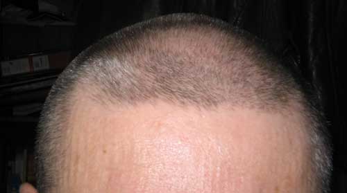 first stage of hair loss - this photo shows the first stage of hair loss