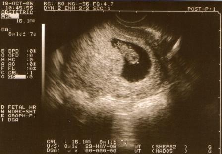 photo - 3 months embryo