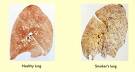 Smoking and Non-Smoking Lungs - Human lungs