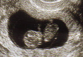 Fetal Picture - Taken at 3 months if i remember correctly