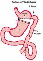 rny - This is a photo of the gastric bypass surgery called Rou-en-y. or commmonly called RNY.