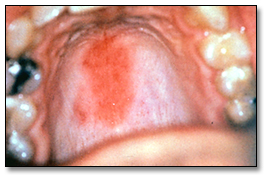 std - mouth with std