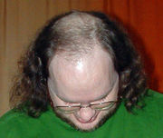 baldness in men - a bald man