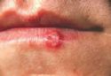Cold sores - I don't get these any more! - Cold sores - I don't get these any more, because of ice cubes!