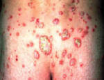 Plaque Psoriasis - Plaque Psoriasis is only one form of the condition there are many variations ranging from circular, scalp, scale, and pustule. There are temporary remedies for psoriasis, but one much continue treatment and will at times have 'flare' ups.