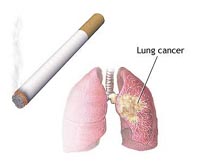 Lung cancer - Cancer