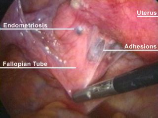 Picture of advanced Endometriosis - This is a picture of Endometriosis in the advanced stage.