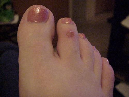 injured toe - toe suffering from a broken blister on top that won't heal and is very painful
