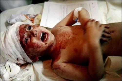 Injured Palestine Child - An Injured Palestine Child cring on bed of hospital