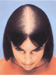 woman hair loss - photo of woman hair loss effect