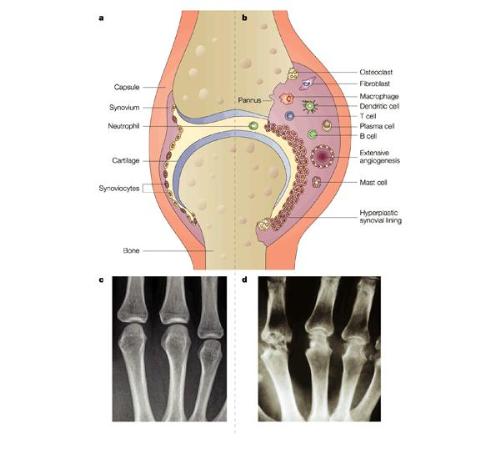 rheumatoid arthritis - Rheumatoid arthritis (RA) is a chronic inflammatory and destructive joint disease that affects 0.5–1% of the population in the industrialized world and commonly leads to significant disability and a consequent reduction in quality of life. It is two to three times more frequent in women than in men and can start at any age, with a peak incidence between the fourth and sixth decade of life, RA is associated with high costs and, if not treated appropriately, with a reduction in life expectancy. In addition to the joint swelling and pain caused by the inflammatory process, the ultimate hallmark of RA is joint destruction.