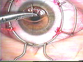 eye surgery - This is an eye surgery