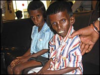This is the picture of a flouride affected guy - The guy in the picture can never be cured of fluorosis. How sad it is?
